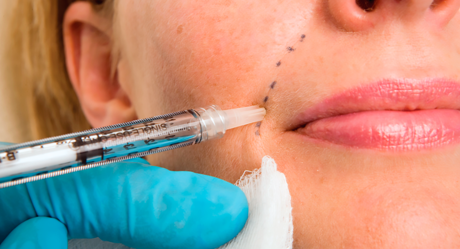 Dermal Fillers Vadodara